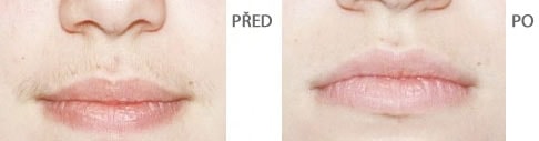 Trvalá depilace - Před a Po - Ret